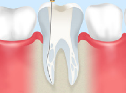 審美　歯の根虫歯